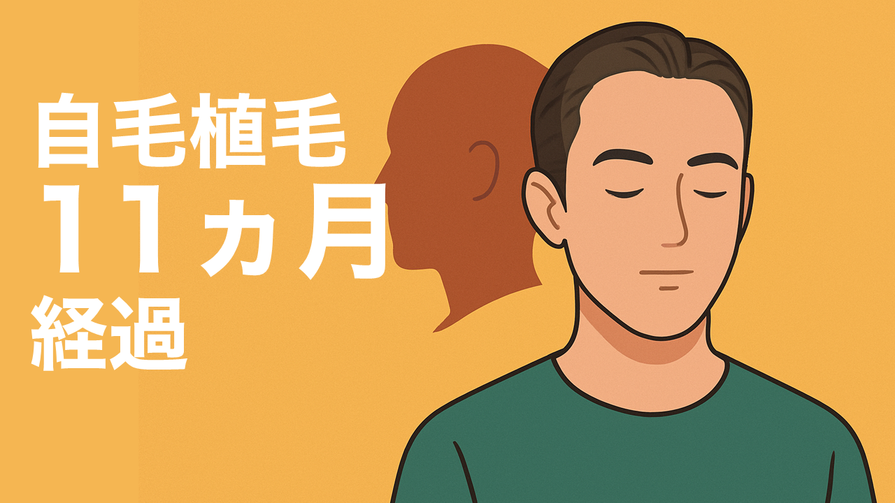 自毛植毛11か月経過｜満足したからこそ「もっと植毛したい」と思えてきた理由